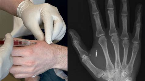 RFID Chips in the Human Body: How Th